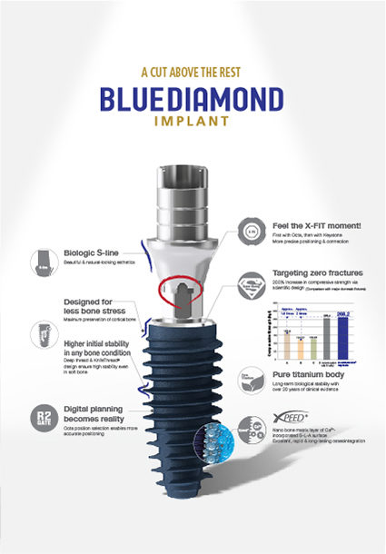 Masterpiece of Implant Technology, BlueDiamond Implant!