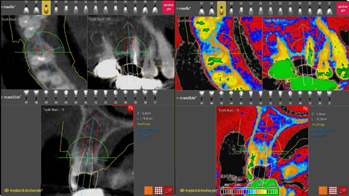 R2gate Digital Guided Surgery - MegaGen Oceania