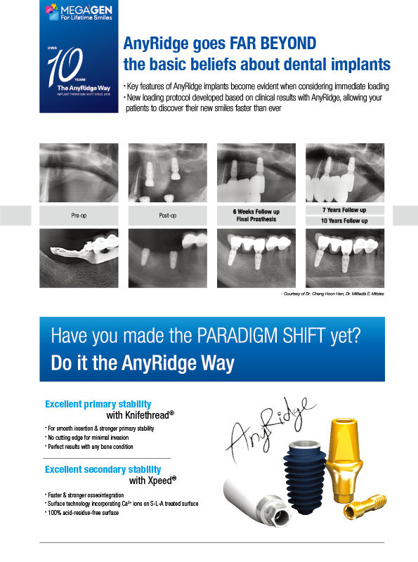 Anyridge goes FAR BEYOND the basic beliefs about dental implants