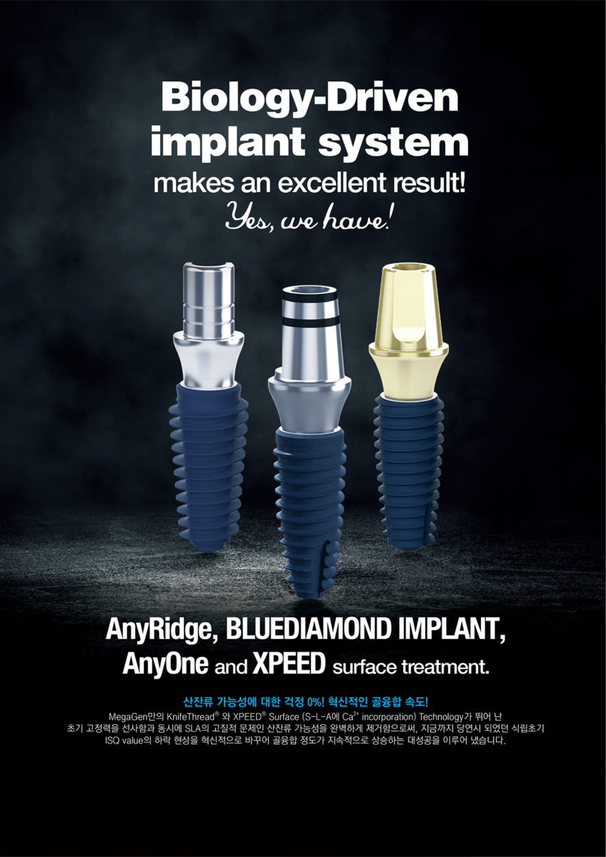 Biology-Driven implant system makes an excellent result!