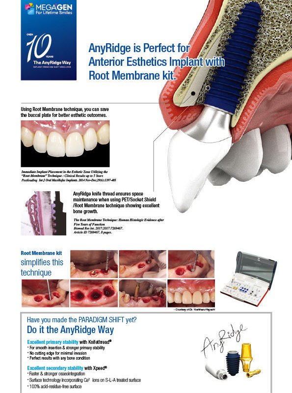 AnyRidge is Perfect for Anterior Esthetics Implant with Root Membrane kit.