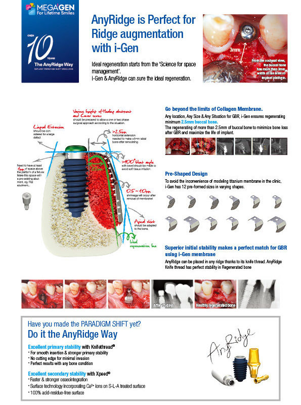 AnyRidge is Perfect for Ridge augmentation with i-Gen