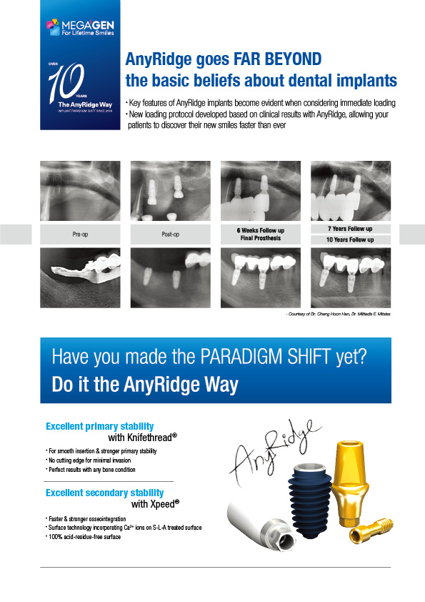 Anyridge goes FAR BEYOND the basic beliefs about dental implants