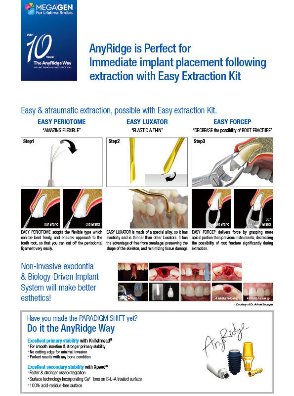 AnyRidge is Perfect for Immediate implant placement following extraction with Easy Extraction Kit