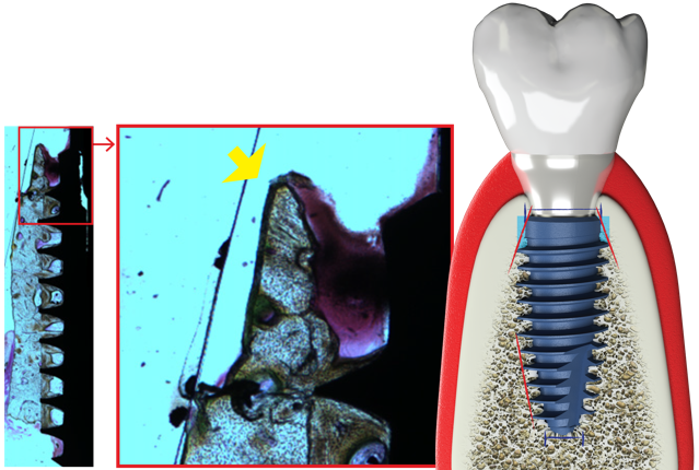 BLUEDIAMOND IMPLANT® - MEGAGEN IMPLANT