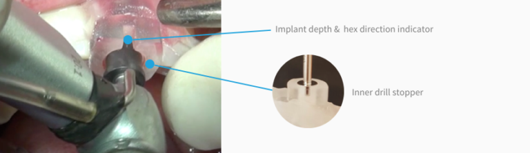 R2GATE® - MEGAGEN IMPLANT