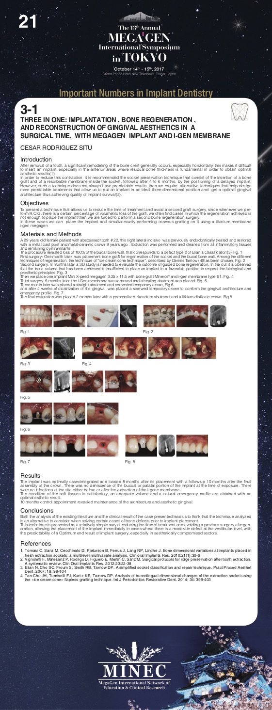 THREE IN ONE: IMPLANTATION , Bone regeneration, AND RECONSTRUCTION OF  GINGIVAL AESTHETICS IN A SURGICAL TIME, WITH MEGAGEN IMPLANT AND I-GEN  MEMBRANE - MEGAGEN IMPLANT