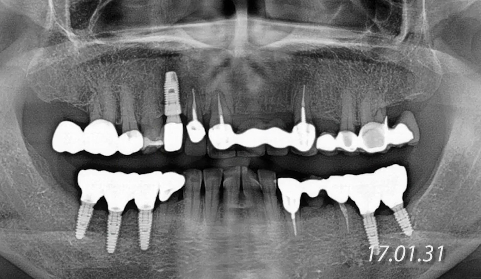 11,12,23,24 Root Membrane Technique with Digital R2GATE Surgery MEGAGEN IMPLANT