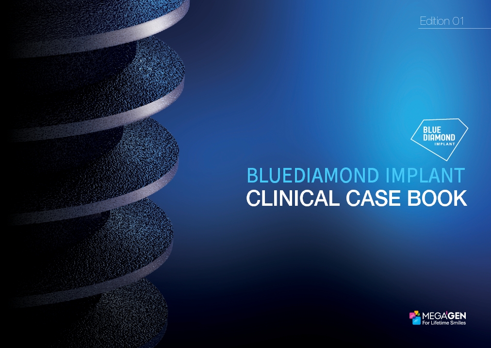 BLUEDIAMOND IMPLANT Clinical Case 7 - Full-mouth rehabilitation using ...