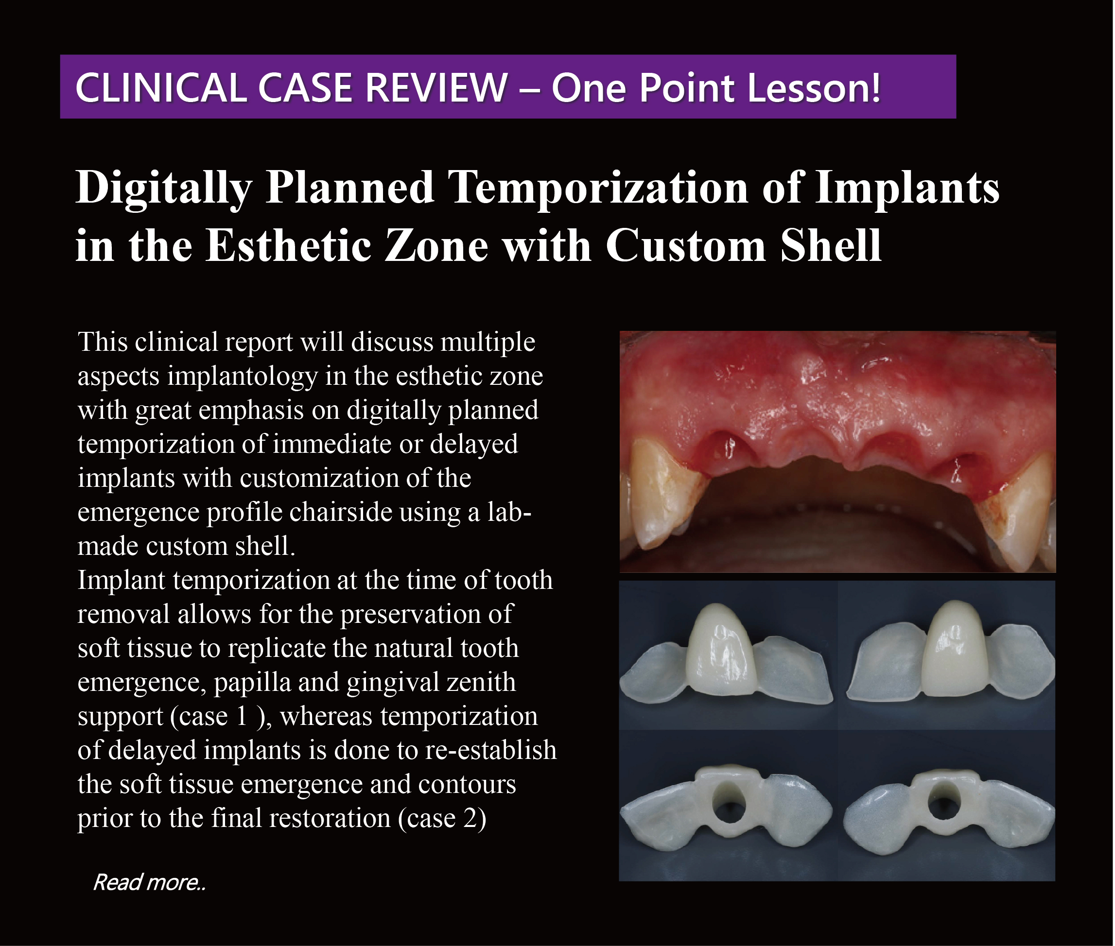 Case Review-Digitally Planned Temporization of Implants in the Esthetic Zone with Custom Shell 